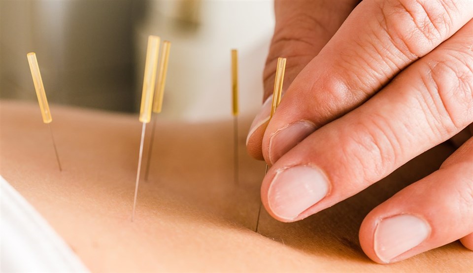 What is Acupuncture?